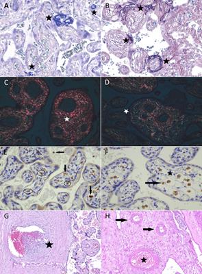 Association Between COVID-19 Pregnant Women Symptoms Severity and Placental Morphologic Features